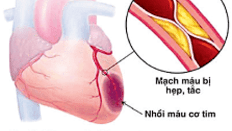 BỆNH TIM MẠCH - KẺ GIẾT NGƯỜI THẦM LẶNG